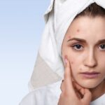 Natural Remedies for Acne - Keralam Chronicles