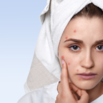 Top 10 Natural Remedies for Acne - Keralam Chronicles