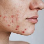 Understanding the Role of Hormones in Acne